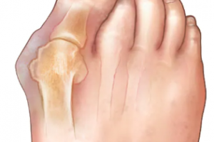 All About Bunions
